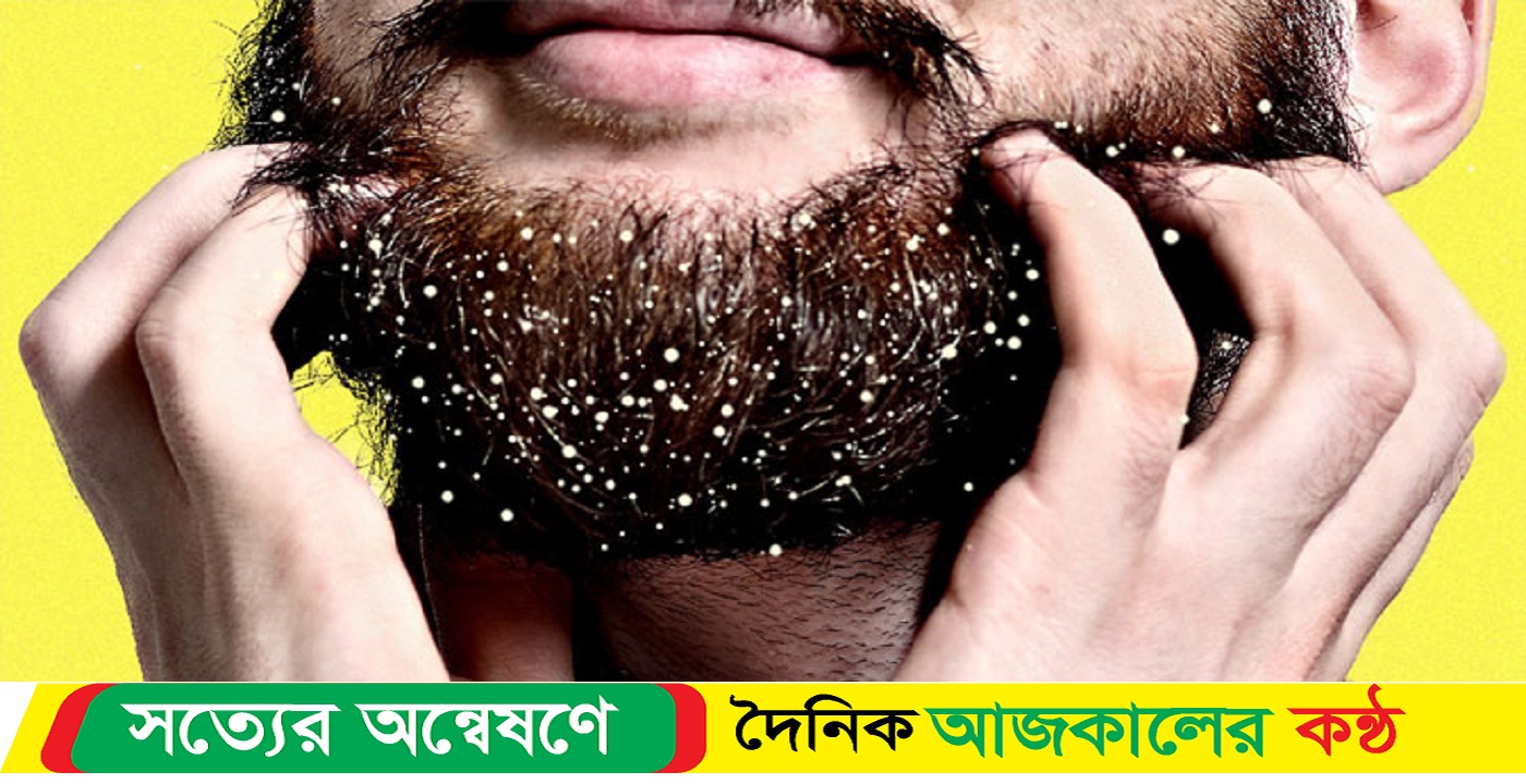 দাড়িতে খুশকি হলে করণীয়