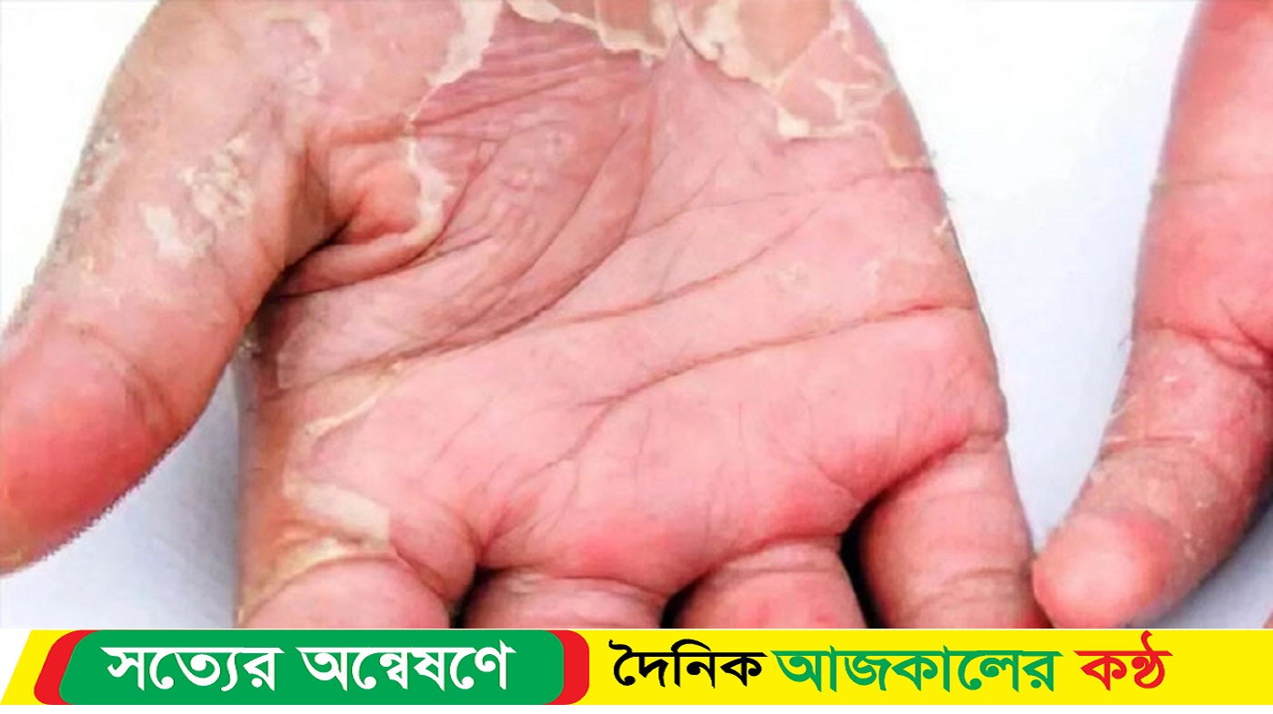 হাত ও পায়ের চামড়া ওঠলে যা করবেন