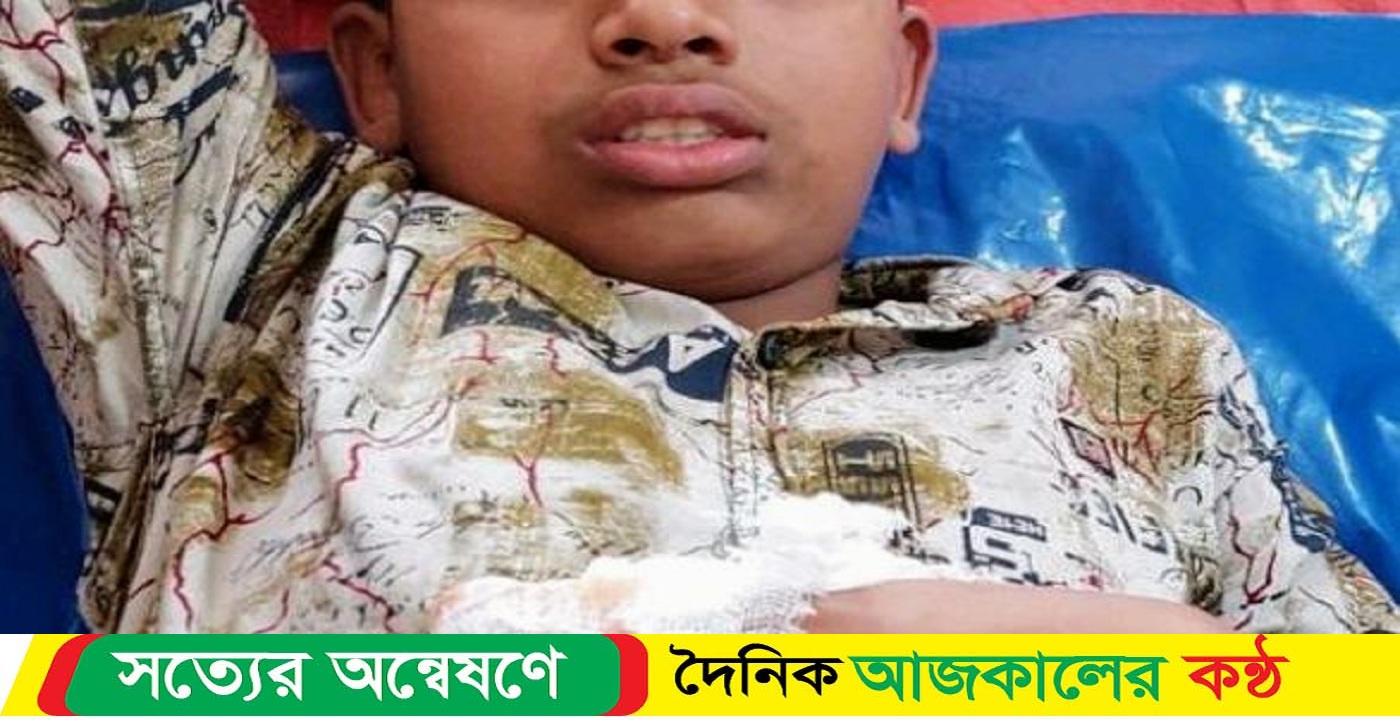 মোরেলগঞ্জে নিজের বানানো আতশবাজিতে আঙ্গুল বিচ্ছিন্ন কিশোরের