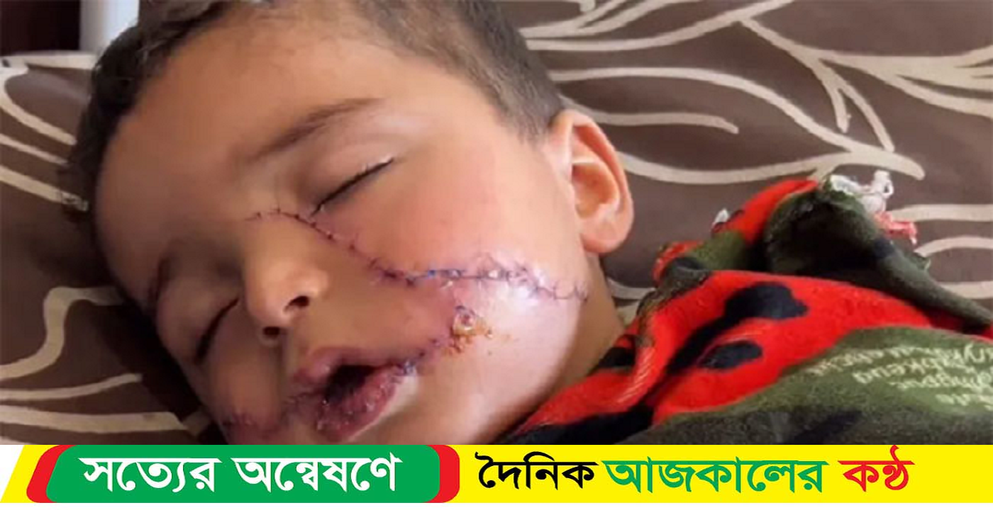 ২০০ সেলাই আহত ফিলিস্তিনি শিশুর মুখে