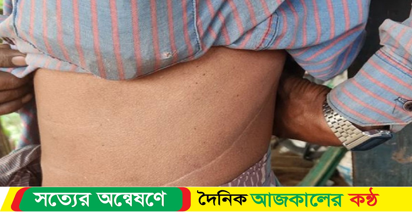 চাকরির আশায় ভারতে গিয়ে কিডনি খোয়ালেন ৩ বাংলাদেশি