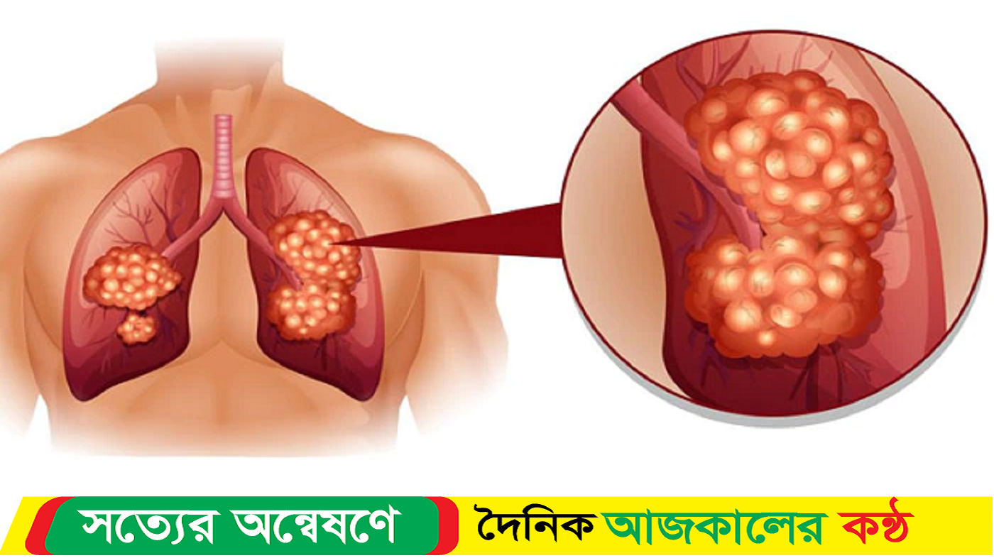 ফুসফুসে ক্যানসারের লক্ষণ বুঝবেন যেভাবে
