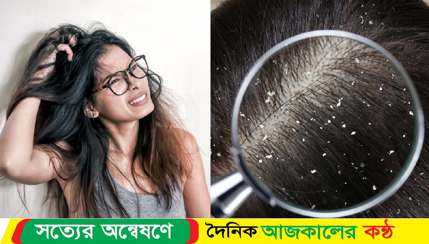 ঘরোয়া উপায়েই খুশকি সমস্যার সমাধান