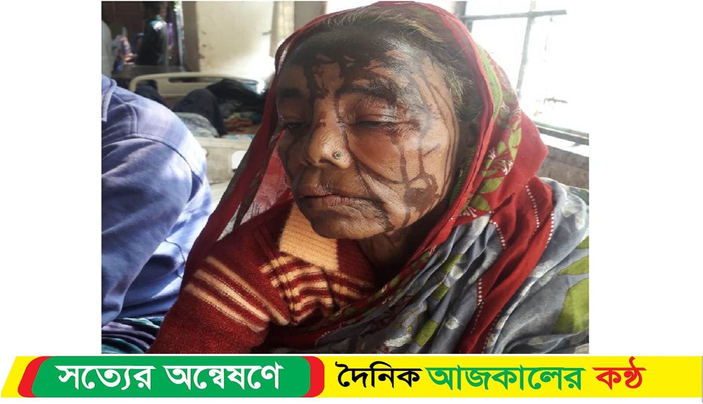 বৃদ্ধাকে এসিড নিক্ষেপ, দুইদিন পেড়িয়ে গেলেও মামলা নেয়নি পুলিশ