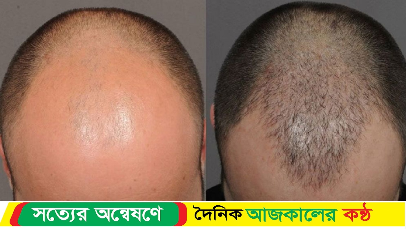 এক মাসেই চুল পড়া বন্ধ ও টাকে গজাবে চুল, কিন্তু কীভাবে?
