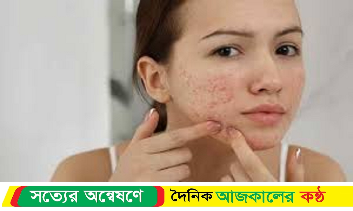 গরমে বাড়ছে ব্রণ, কিন্তু কেন ?