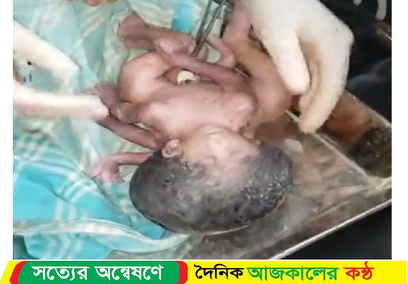 জমজ, অথচ একসাথে নিথর জোড়া লাগানো শিশু জন্ম নিয়ে কান্নার রোল