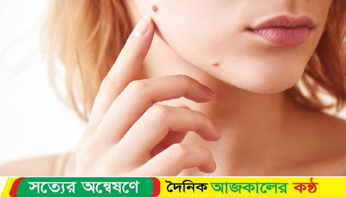 ঘরোয়া উপায়ে আঁচিল দূর করবেন যেভাবে