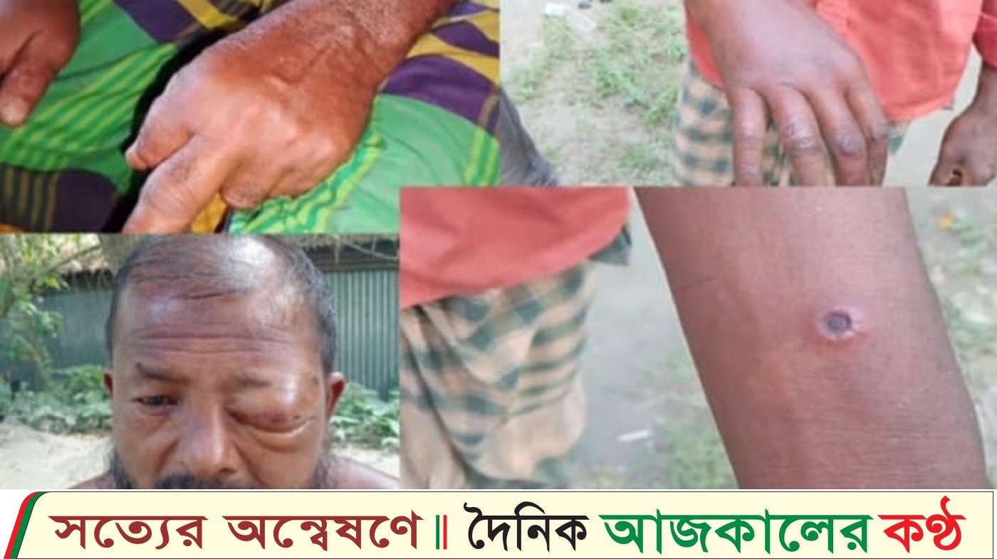 গাইবান্ধার সুন্দরগঞ্জে অসুস্থ গরু জবাইয়ের পর অন্তত ১১ জন অ্যানথ্রাক্স রোগে আক্রান্ত