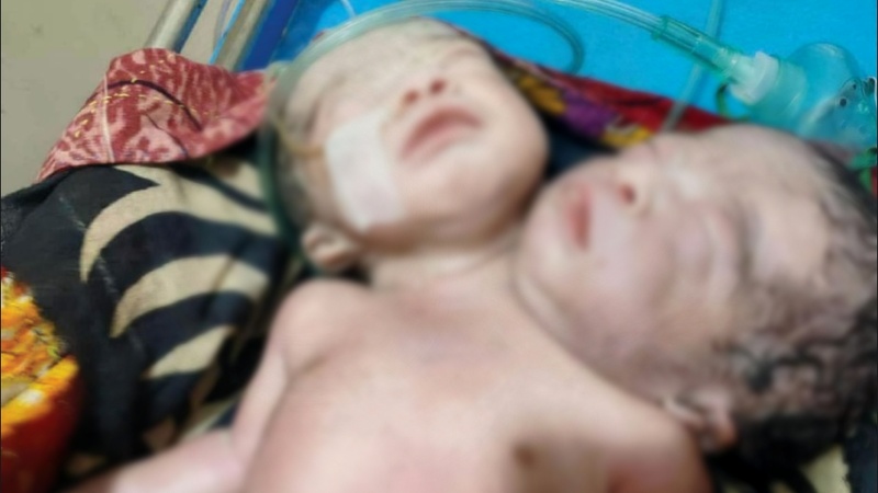 পিরোজপুরে দুই মাথা ও এক দেহ বিশিষ্ট বিরল শিশুর জন্ম