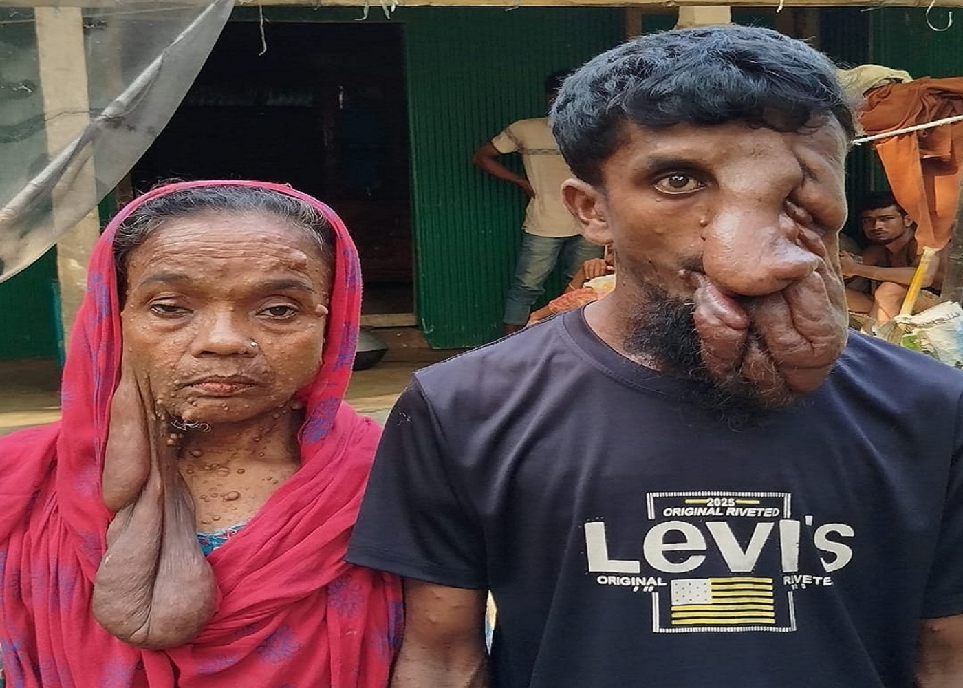 বারহাট্রায় বিরল রোগে মা-ছেলের জীবন চিকিৎসার অভাবে নিভে যাচ্ছে